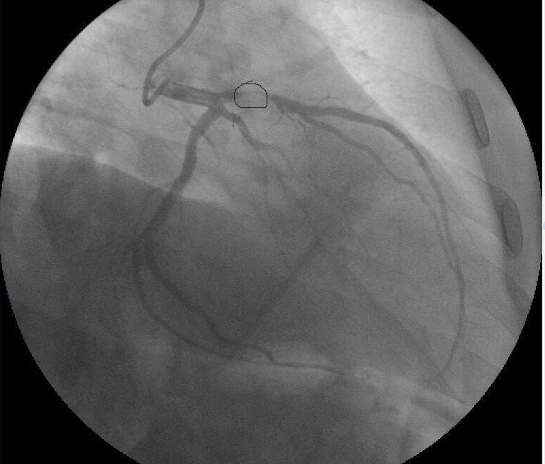  Світла ниточка, просвіт у 5% кровотоку, яка врятувала 32-річному чернівчанину Ігореві Грабюку життя.